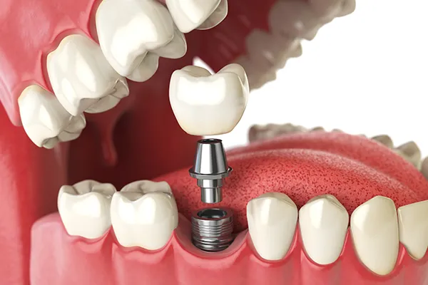 dental implant 1