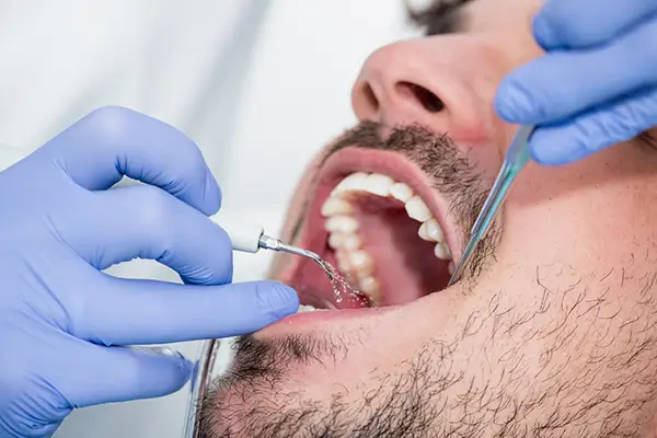 Dentist performing a periodontal cleaning procedure on a male patient using dental tools to remove plaque due to dehydration.